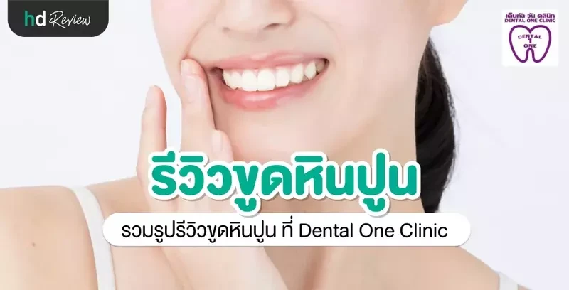 รีวิว ขูดหินปูน ที่ Dental One Clinic
