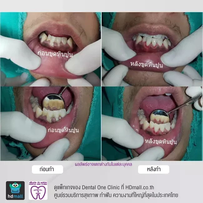 รีวิว ขูดหินปูน ที่ Dental One Clinic