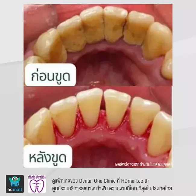 รีวิว ขูดหินปูน ที่ Dental One Clinic