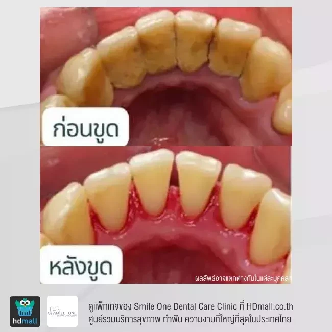 รีวิว ขูดหินปูน ที่ Smile One Dental Care Clinic