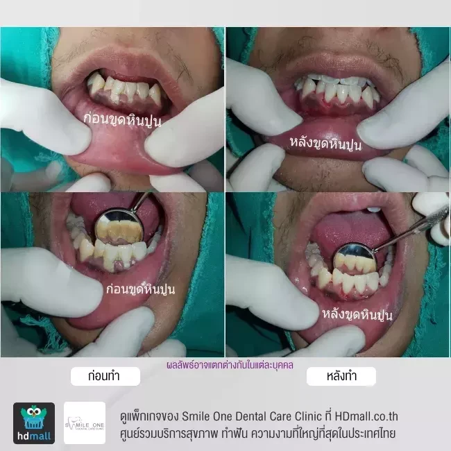 รีวิว ขูดหินปูน ที่ Smile One Dental Care Clinic