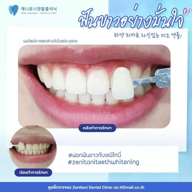 รีวิว ฟอกสีฟัน ที่ Zenitoni Dental Clinic