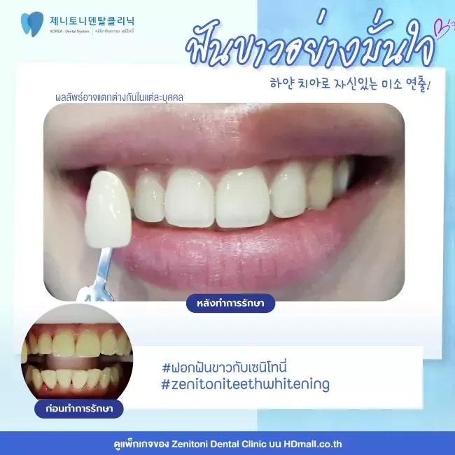 รีวิว ฟอกสีฟัน ที่ Zenitoni Dental Clinic