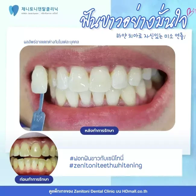 รีวิว ฟอกสีฟัน ที่ Zenitoni Dental Clinic