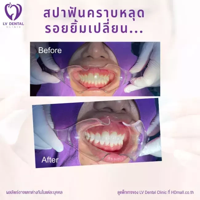 รีวิว สปาฟัน Air Flow ที่ LV Dental Clinic