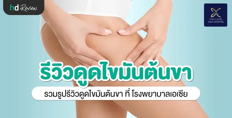 รีวิว ดูดไขมันต้นขา ที่ โรงพยาบาลเอเซีย