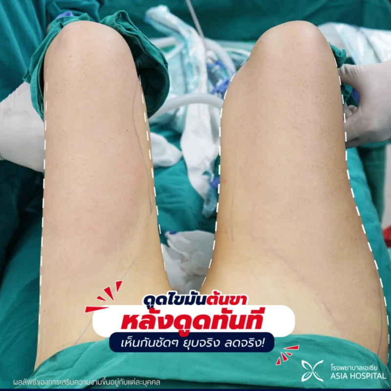 รีวิว ดูดไขมันต้นขา ที่ โรงพยาบาลเอเชีย