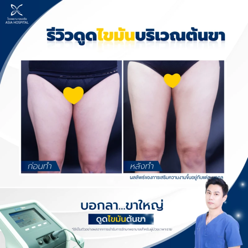 รีวิว ดูดไขมันต้นขา ที่ โรงพยาบาลเอเชีย