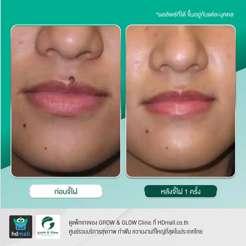 รีวิว จี้ไฝ จี้กระ ที่ GROW & GLOW Clinic