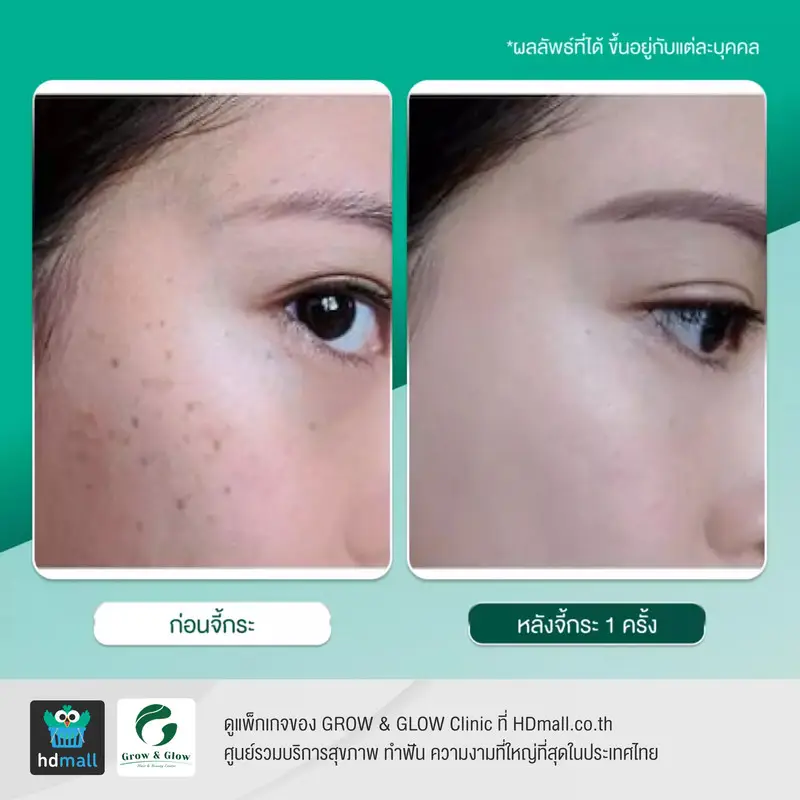 รีวิว จี้ไฝ จี้กระ ที่ GROW & GLOW Clinic