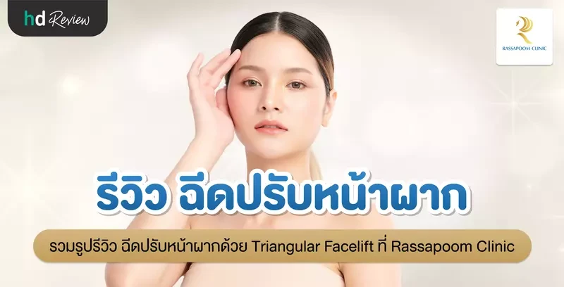 รีวิว ฉีดปรับหน้าผากด้วย Triangular Facelift ที่ Rassapoom Clinic (รัสมิ์ภูมิคลินิก)