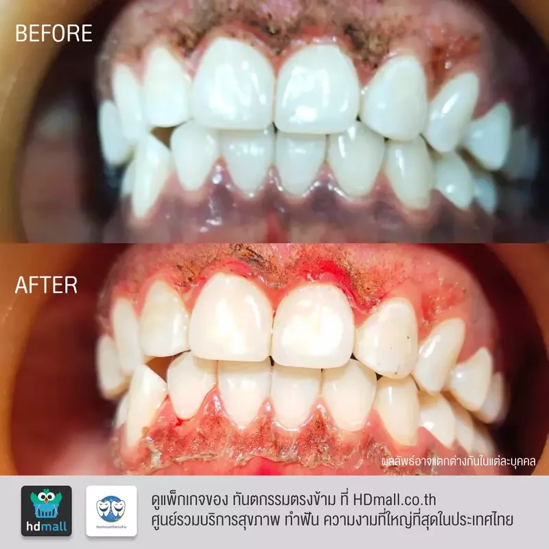 รีวิว ตัดแต่งเหงือก ที่ ทันตกรรมตรงข้าม