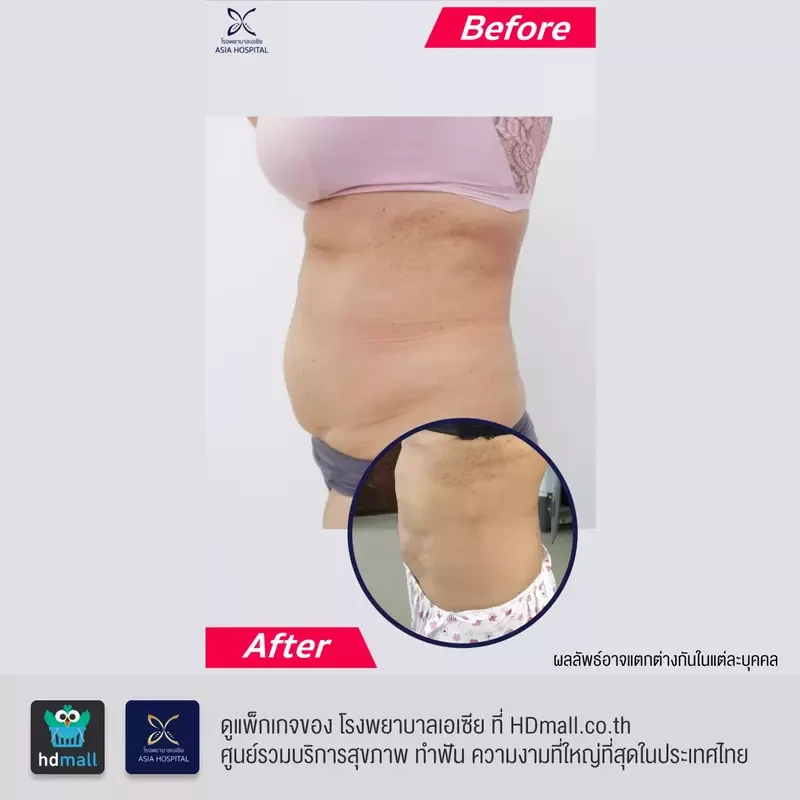รีวิว ดูดไขมันท้อง ที่ โรงพยาบาลเอเซีย