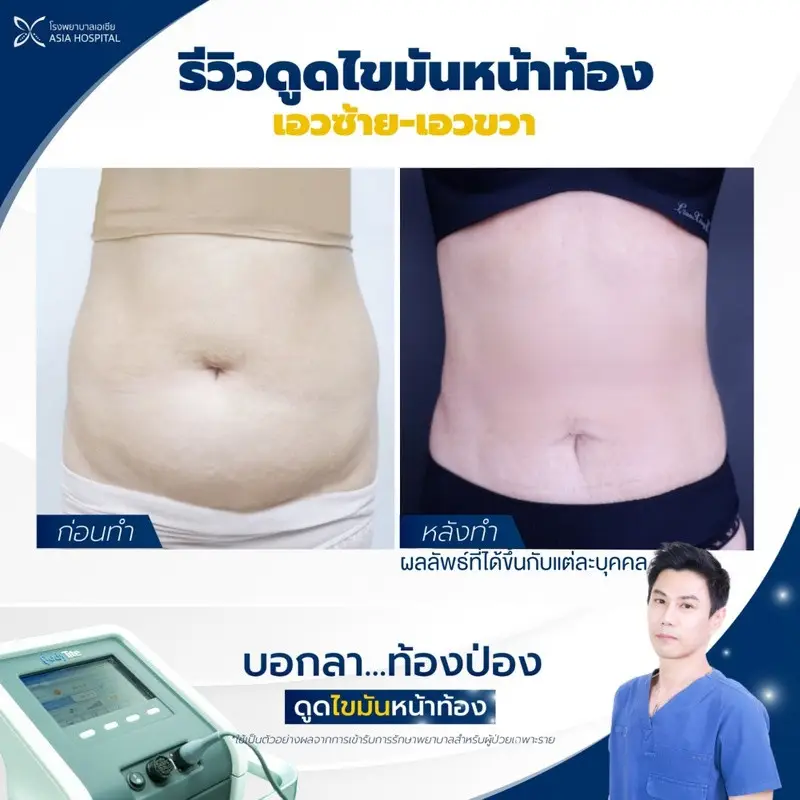 รีวิว ดูดไขมันท้อง ที่ โรงพยาบาลเอเซีย