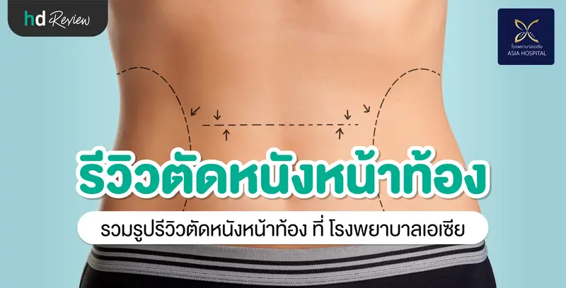 รีวิว ตัดหนังหน้าท้อง ที่ โรงพยาบาลเอเซีย