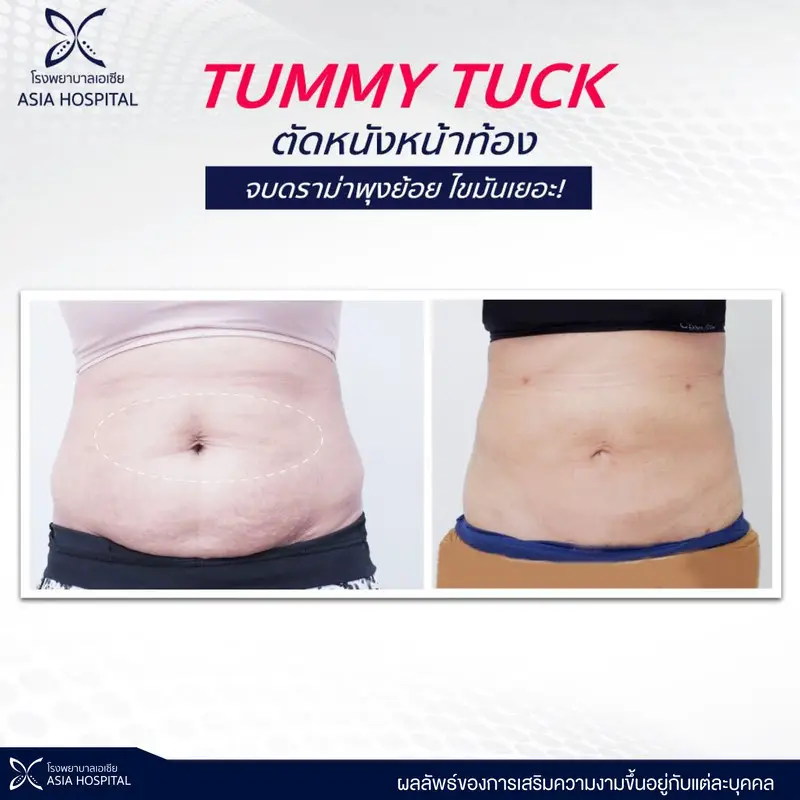 รีวิว ตัดหนังหน้าท้อง ที่ โรงพยาบาลเอเชีย