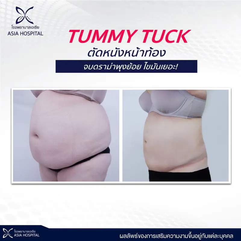 รีวิว ตัดหนังหน้าท้อง ที่ โรงพยาบาลเอเชีย