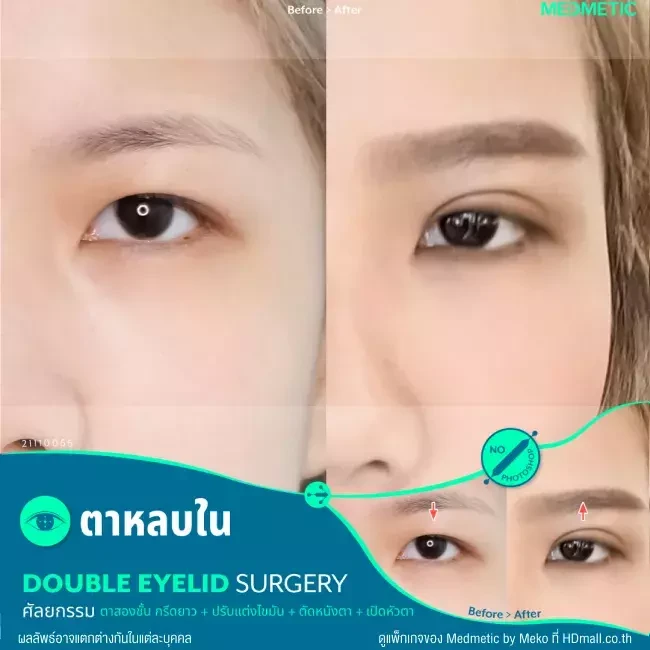 รีวิว ทำตาสองชั้น จัดเรียงไขมันใต้ตาบน ที่ Medmetic by Meko