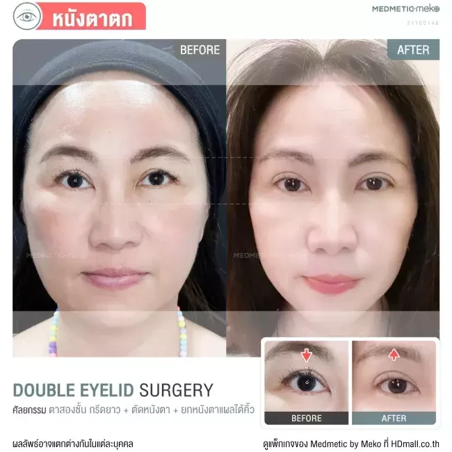 รีวิว ทำตา ผ่าตัดตกแต่งหนังตาบน ที่ Medmetic by Meko