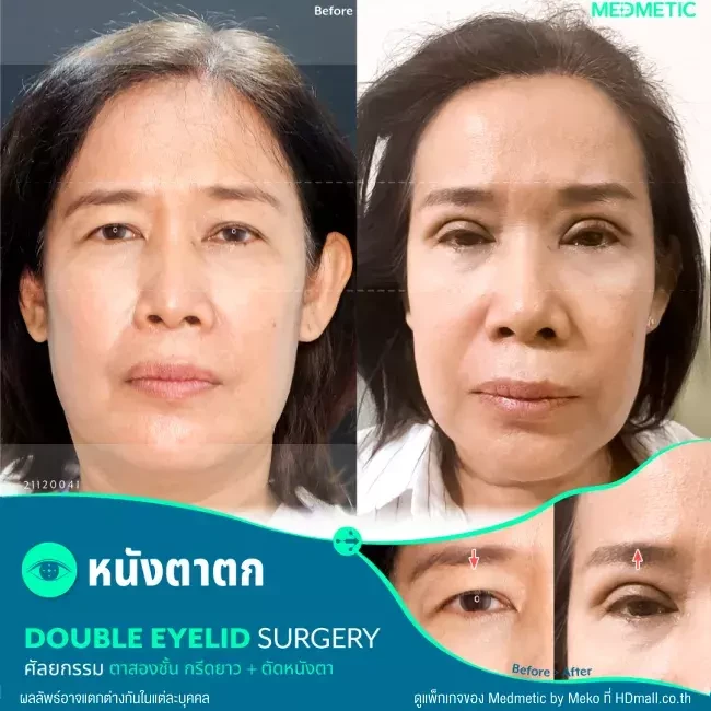 รีวิว ทำตา ผ่าตัดตกแต่งหนังตาบน ที่ Medmetic by Meko