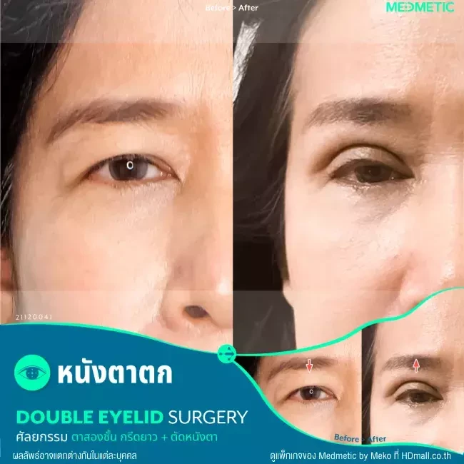 รีวิว ทำตา ผ่าตัดตกแต่งหนังตาบน ที่ Medmetic by Meko