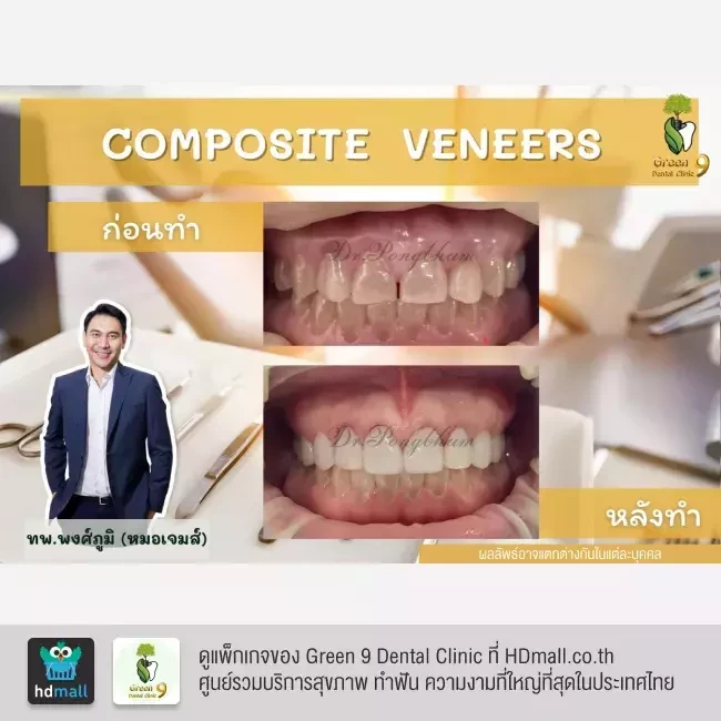 รีวิว เคลือบฟัน ทำวีเนียร์ ที่ Green 9 Dental Clinic
