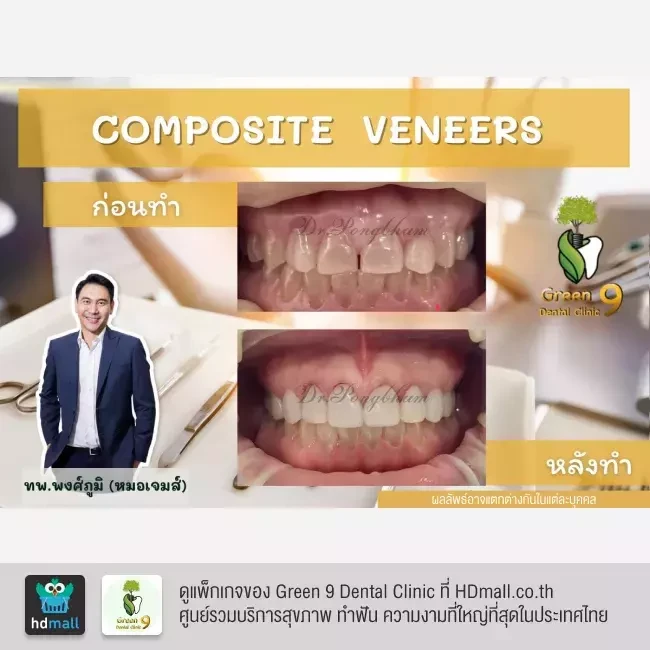 รีวิว เคลือบฟัน ทำวีเนียร์ ที่ Green 9 Dental Clinic