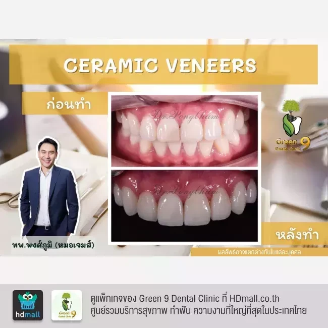 รีวิว เคลือบฟัน ทำวีเนียร์ ที่ Green 9 Dental Clinic