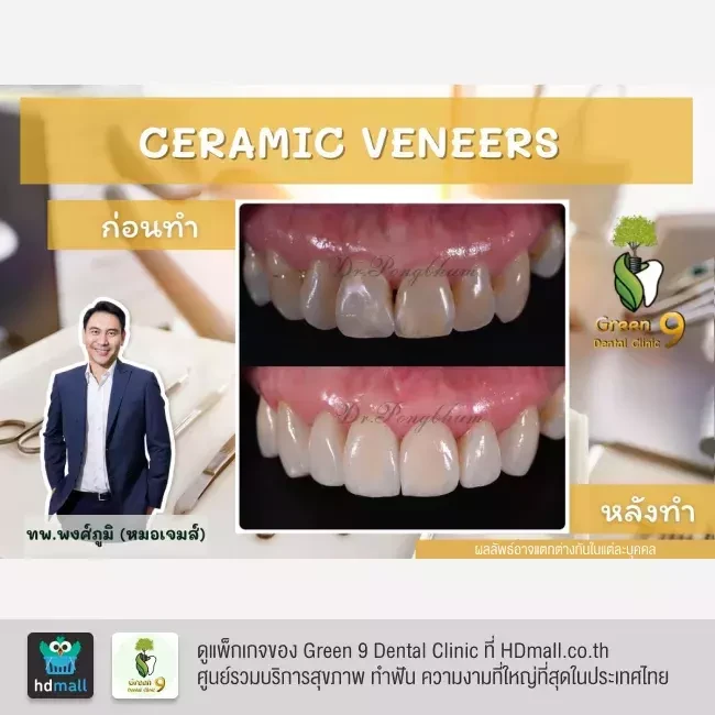 รีวิว เคลือบฟัน ทำวีเนียร์ ที่ Green 9 Dental Clinic