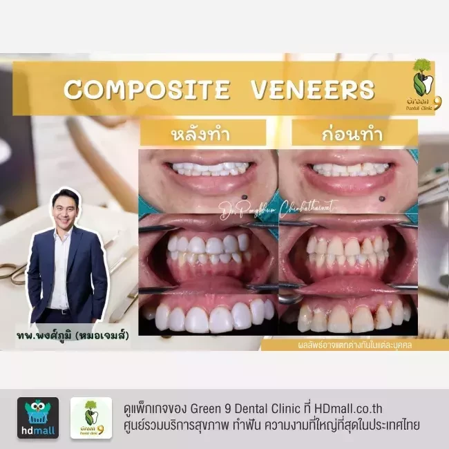 รีวิว เคลือบฟัน ทำวีเนียร์ ที่ Green 9 Dental Clinic
