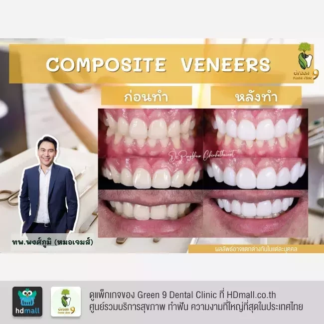 รีวิว เคลือบฟัน ทำวีเนียร์ ที่ Green 9 Dental Clinic