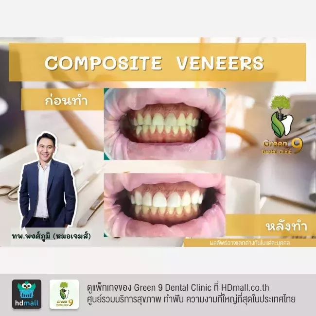 รีวิว เคลือบฟัน ทำวีเนียร์ ที่ Green 9 Dental Clinic