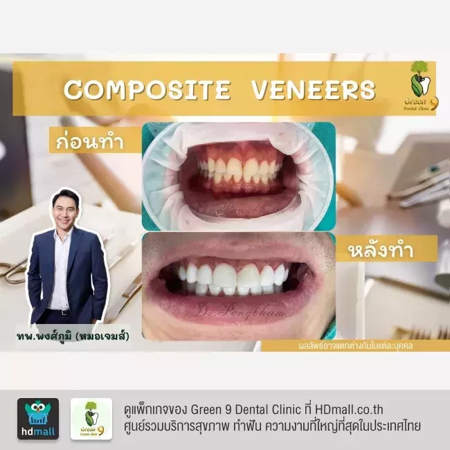 รีวิว เคลือบฟัน ทำวีเนียร์ ที่ Green 9 Dental Clinic