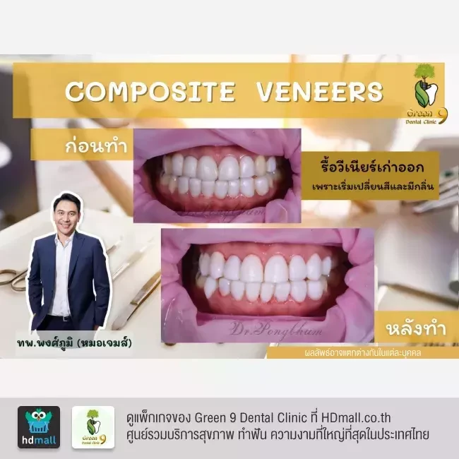 รีวิว เคลือบฟัน ทำวีเนียร์ ที่ Green 9 Dental Clinic