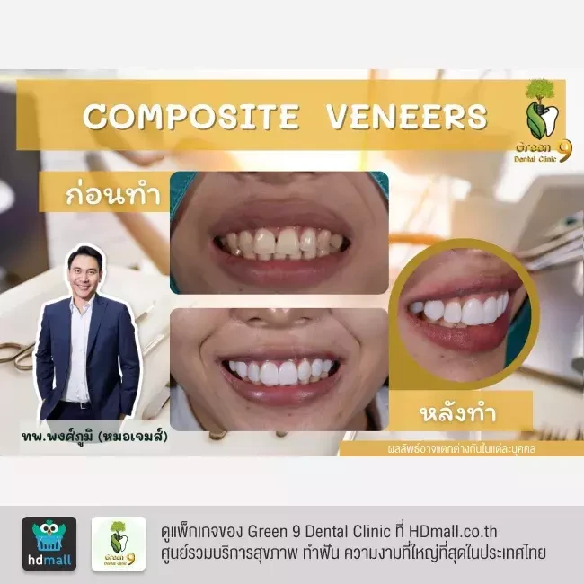 รีวิว เคลือบฟัน ทำวีเนียร์ ที่ Green 9 Dental Clinic