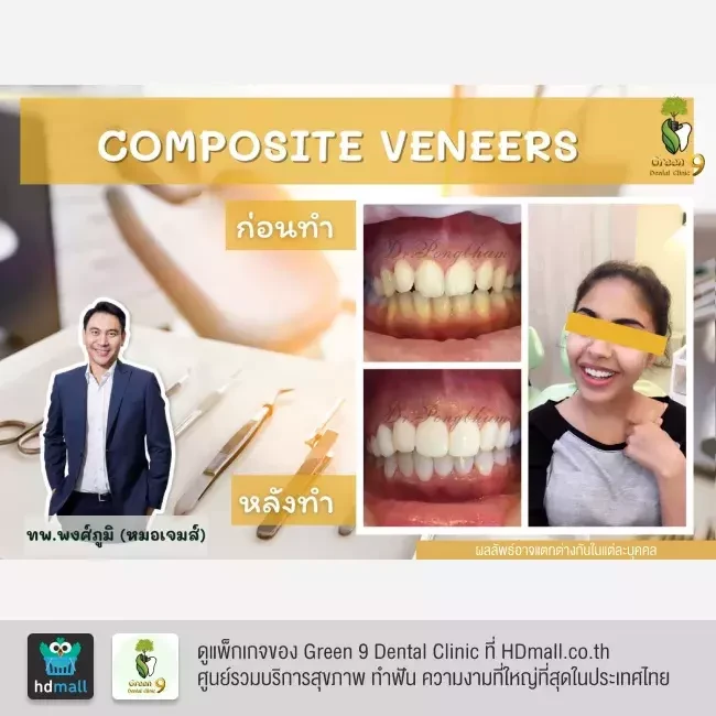 รีวิว เคลือบฟัน ทำวีเนียร์ ที่ Green 9 Dental Clinic