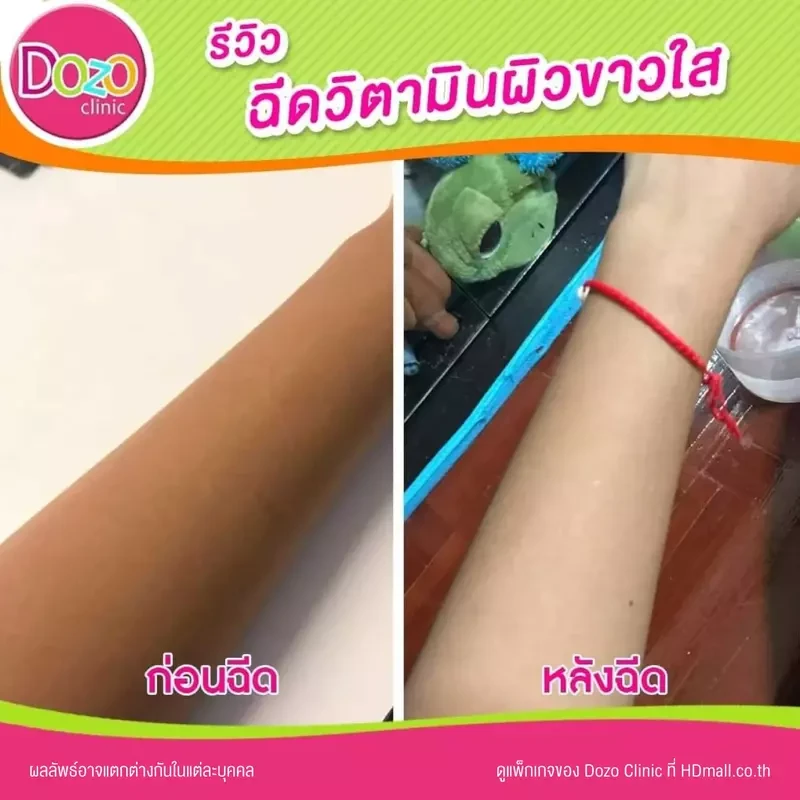 รีวิว ดริปวิตามิน สูตร Aura Drip เพื่อผิวกระจ่างใส ที่ Dozo Clinic