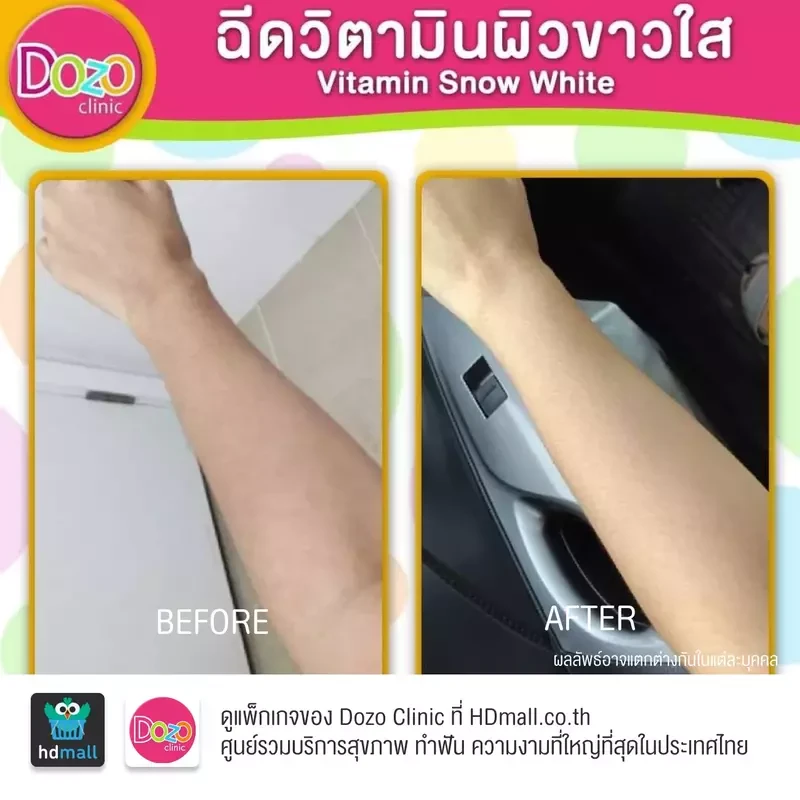 รีวิว ดริปวิตามิน สูตร Aura Drip เพื่อผิวกระจ่างใส ที่ Dozo Clinic
