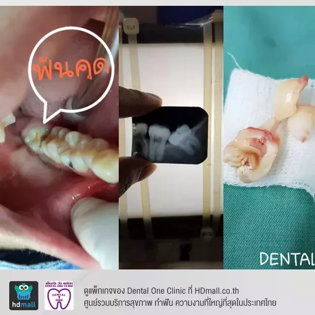 รีวิว ผ่าฟันคุด ที่ Dental One Clinic