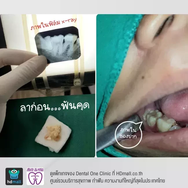 รีวิว ผ่าฟันคุด ที่ Dental One Clinic