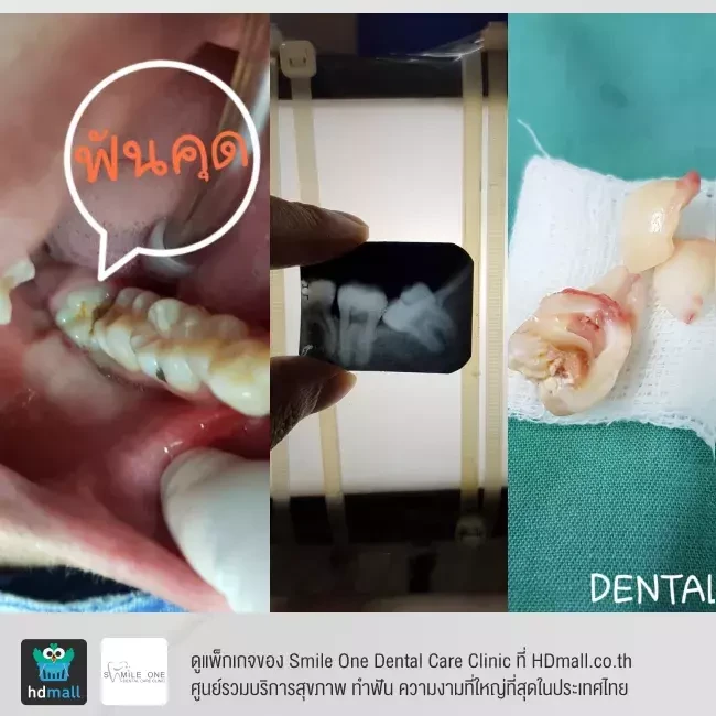 รีวิว ผ่าฟันคุด ที่ Smile One Dental Care Clinic