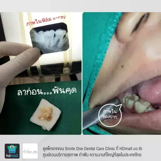 รีวิว ผ่าฟันคุด ที่ Smile One Dental Care Clinic