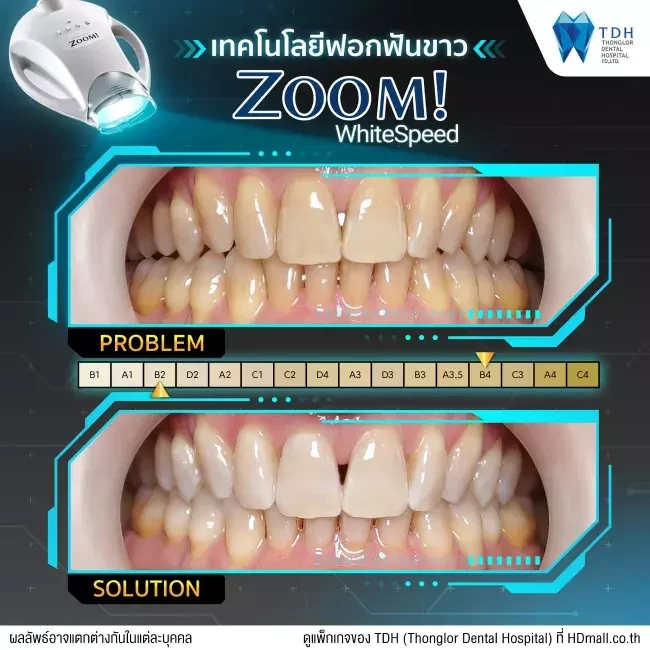 รีวิว ฟอกสีฟันแบบ Zoom ที่ Thonglor Dental Hospital (TDH)