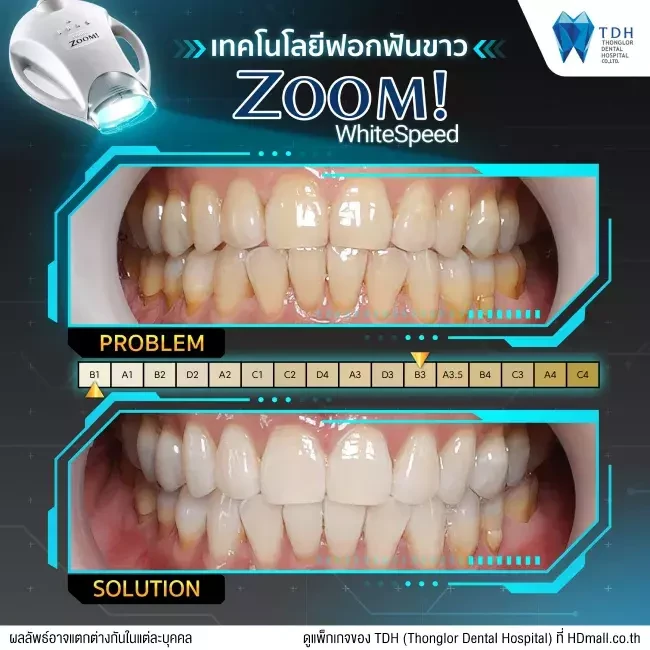 รีวิว ฟอกสีฟันแบบ Zoom ที่ Thonglor Dental Hospital (TDH)