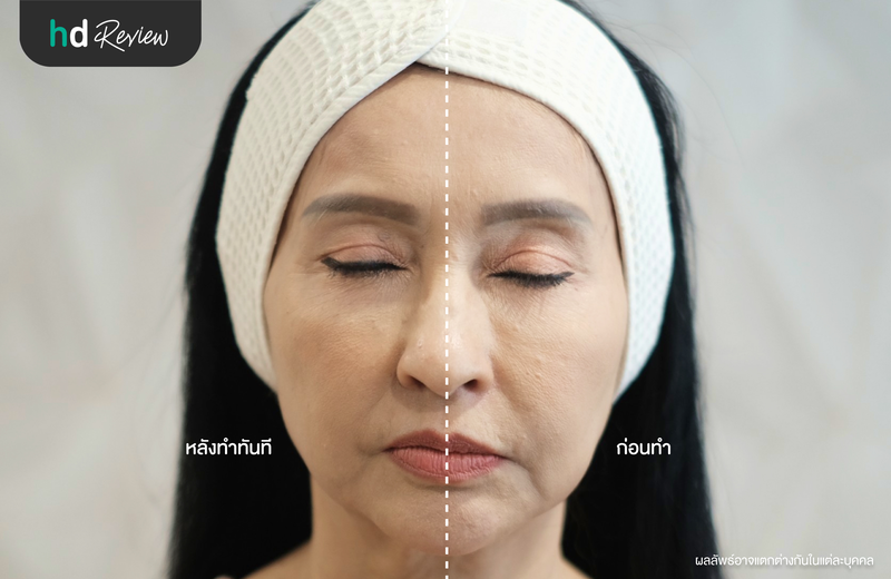 เปรียบเทียบผลลัพธ์ก่อนกับหลังฉีดโบท็อกซ์ลิฟต์หน้า