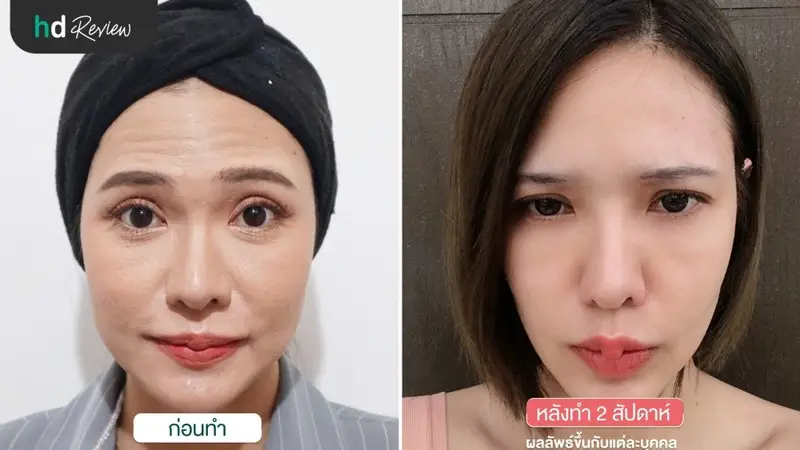 content review botulinum toxin injections korea aestox at anjali clinic by neeranara boonchuai 2