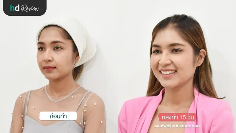 ก่อนและหลังฉีดโบท็อกซ์ริ้วรอย ที่ Bless Clinic สุพรรณบุรี