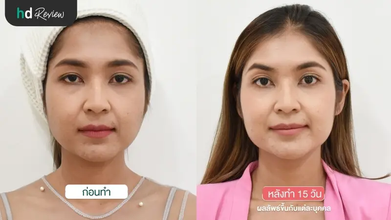 ก่อนและหลังฉีดโบท็อกซ์ริ้วรอย ที่ Bless Clinic สุพรรณบุรี
