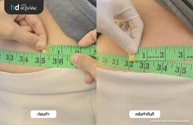 ผลลัพธ์หลังสลายไขมันด้วยความเย็น Cool Slim