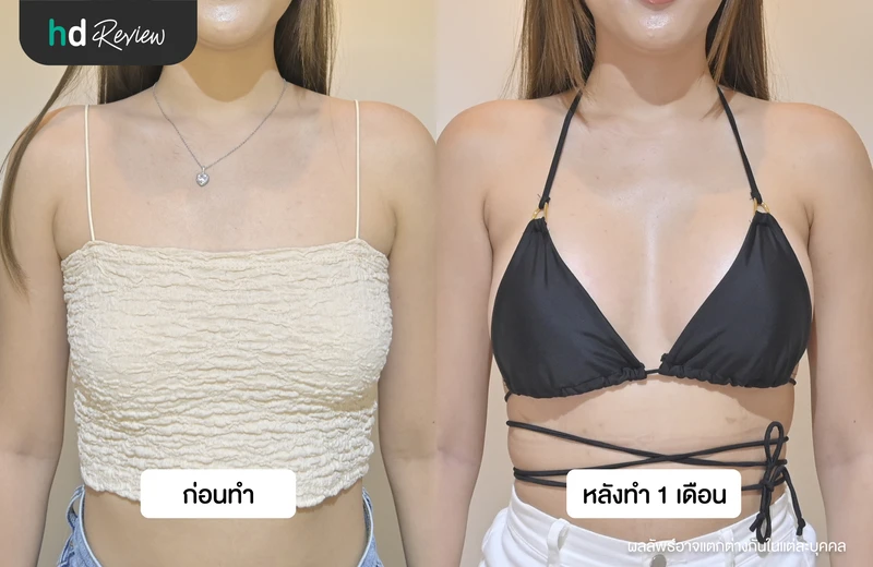 ภาพเปรียบเทียบผลลัพธ์ก่อนเสริมหน้าอกและหลังเสริมหน้าอกครบ 1 เดือน